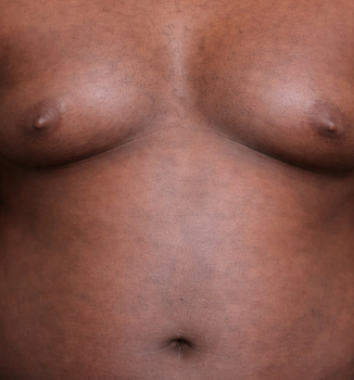 Lipomastia: o que é, quando é indicado, tratamentos